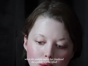 Eyelids