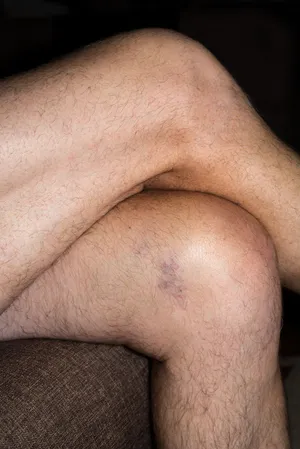 Firmly Pinch The Skin Together artwork